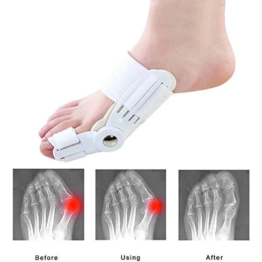 BunionFixed™ – Bunion Corrector Splint